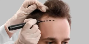 Long-Term Results: Maximizing the Density of Your Hair Transplant UK