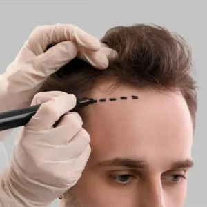 Long-Term Results: Maximizing the Density of Your Hair Transplant UK