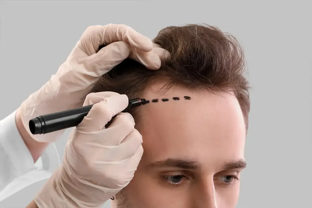 Long-Term Results: Maximizing the Density of Your Hair Transplant UK